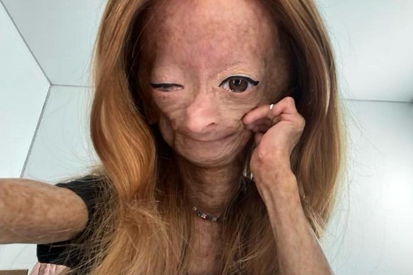 YouTuber Adalia Rose Williams dead at 15: ‘She is no longer in pain’
