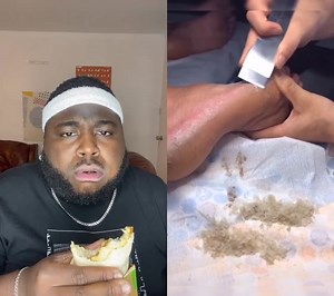 Expert Foot Care: Removing Calluses Safely