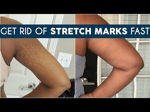HOW TO GET RID OF STRETCH MARKS EASILY