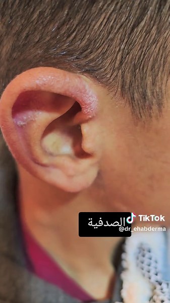 العلاج والتعايش مع الصدفية: نصائح هامة