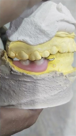 Lower Removable Cost Partial Denture 😁😁😁#rpddentalprocedure