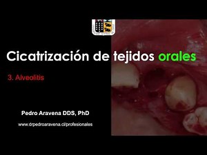 Wound healing oral surgery. 3/3 Alveolar osteitis Dry Socket