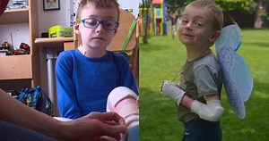 Vojtíšek (9) trpí nemocí »z pekla«: Puchýře v krku, bez nehtů i zubů a se srostlými prsty