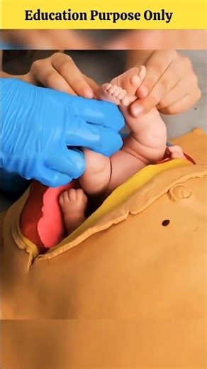 surgery மூலமா இப்படி தான் குழந்தையை வெளியே எடுபாங்க