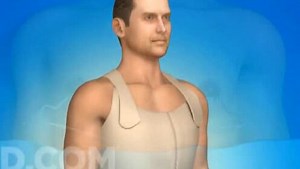 男性乳房发育症手术高清动画展现