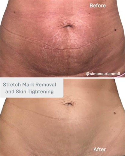 Stretch Mark Removal