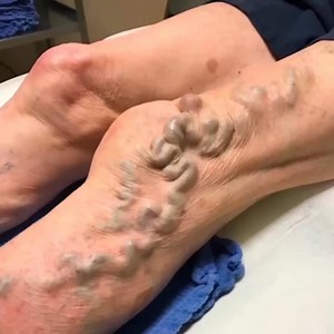 Although veins that are this large can be treated, please don’t wait until they get this big. As the veins stretch the skin over many years and treatment will not leave a good cosmetic outcome. This image is NOT AI generated. It is a real patient who I have seen in consultation. @veintreatmentcenter on IG @sclerotherapyvids on IG (my second channel) www.VeinsVeinsVeins.com @BuffaloVeins on #YouTube VeinsVeinsVeins.com on #TikTok Phone: 716-839-3638 Williamsville, NY and Orchard Park, NY | Vein T
