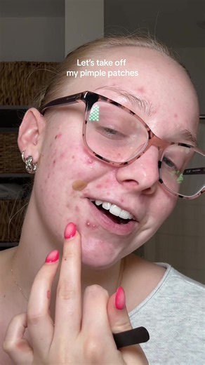 EasyDerm Pimple Patch: The Secret to Slaying Acne?