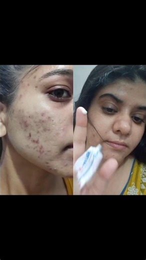 Tretinoin cream 0.05% transformation No acne No dark spot #acne #skincare #tretinoin #darkspots
