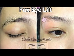 Fox Eye Lift | Brow Lift Full Procedure for only 7,999php