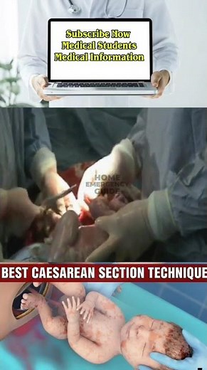 Expert Reveals BEST CAESAREAN SECTION TECHNIQUE