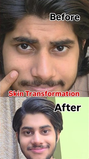 1 Day Skin Transformation 😳 | Before vs After Glow Up ✨