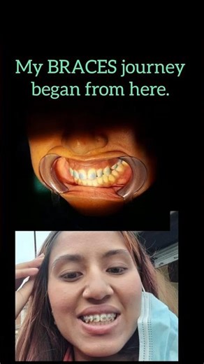 My braces journey #braces #explore #dentist #asmr #shorts #viral #newtrend #trending #love #update
