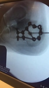 CERAMENT BONE VOID FILLER Injected Under Fluoroscopy