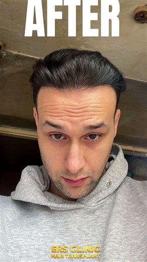 Thank you for choosing us, Mr. Ege #hairtransplant #sacekimi