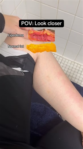 POV: You lose the weight… but your legs still hurt, bruise easily, and feel lumpy. This is not cellulite This is not “normal fat” And it’s not something diet and exercise alone fix. Lipedema fat: • Is fibrotic and painful • Forms nodules • Bruises easily • Can cover muscle even after major weight loss I lost over 100 lbs and this did not go away — because lipedema is a chronic connective tissue disease, not a willpower issue. The good news? There are ways to manage inflammation, pain, and progre