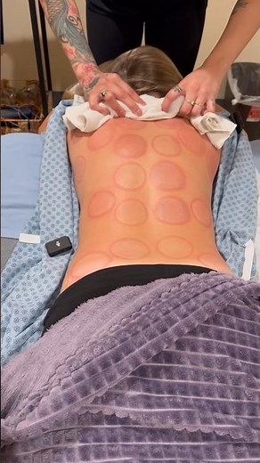 Fire Cupping ASMR 🔥