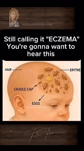 ECZEMA MIGHT NOT BE WHAT YOU THINK 😳🪱 You’ve tried every cream. Cut out dairy. Gone fragrance free. But the rashes keep coming back… What if eczema isn’t just a skin issue? What if it’s a gut issue caused by something living inside you? 👉 Parasites like liver flukes and threadworms release toxins that burden the liver and trigger inflammatory skin conditions like eczema. 👉 They can damage the gut lining, leading to leaky gut and when toxins leak out, your skin tries to push them out too. Ski
