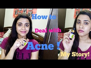 Acne Skincare/ My Acne story/How to deal with Acne मुहांसों के प्रभाव को कैसे कम करें? /Pcos Acne