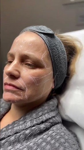 Aesthefill - advanced collagen biostimulator - #Clinicbe #aesthetics #aesthefill #sculptra