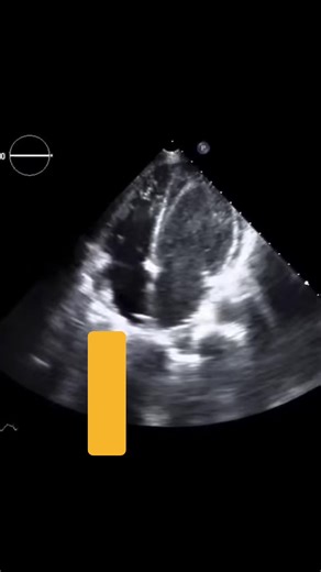 Understanding Ventricular Fibrillation and Echocardiography