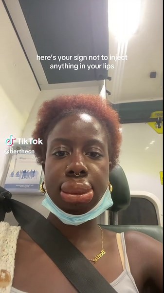 Lip Injection Mistakes: Avoid Common Issues