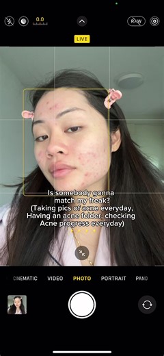 My 4-Year Acne Journey: Progress & Improvement
