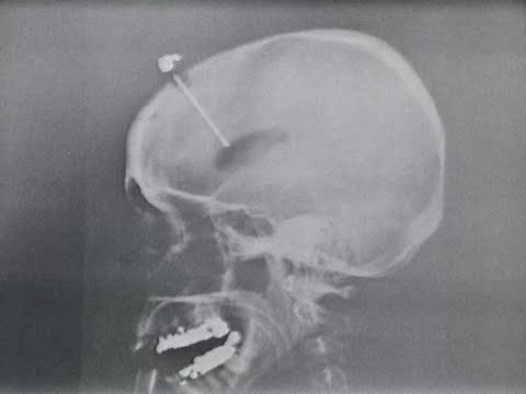 Cingulotomy for Chronic Neuropsychiatric Illness and Intractable Pain (Public Health Service, 1965)