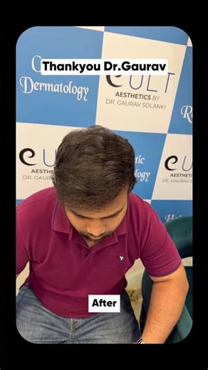 Grade 5 Hair Loss to Full Hairline | Deepak’s Transformation at Cult Aesthetics Gurgaon