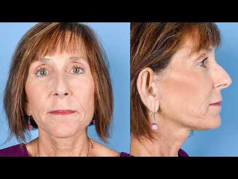 Micro Lift Surgery | Before and After | Dr. Greg Ruff