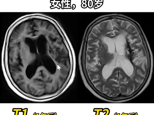 3.MRI快问快答——T2WI低信号