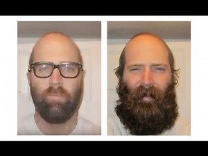 THICKEST BEARD! 6 MONTH TIMELAPSE