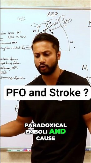 PFO Stroke Diagnosis: Bubble Echo and Closure Explained #shorts