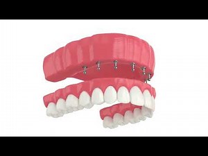 The Ultimate Guide to Upper Snap-On Dentures