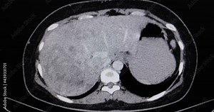 A motion CT scan of an abdomen of a patient with primary liver cancer. Diagnostic CT footage.