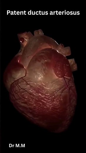 PDA Murmur in 20 Secs! (Classic Sound Demo) #Pediatrics