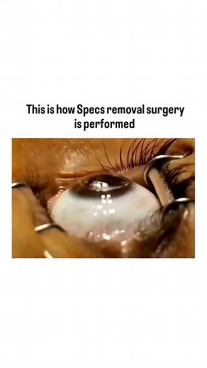 medical_animation on Instagram: "This is the process of specs removal surgery, where advanced laser technology is used to reshape the cornea, correcting vision problems like nearsightedness, farsightedness, or astigmatism. The procedure is quick, minimally invasive, and typically ensures are a a rapid recovery with improved vision. For video credit 🎥: Kindly DM 🙏 Dm for credit or removal All rights reserved to the original creator. #explore #viral #viralreels #science #reels # #eye #eyecare #i