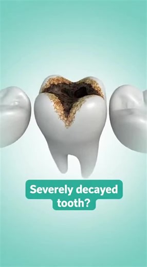 Mike | When a tooth is badly decayed, it may be too weak for a filling or crown. In those cases, removing the tooth can be the healthiest choice.... | Instagram