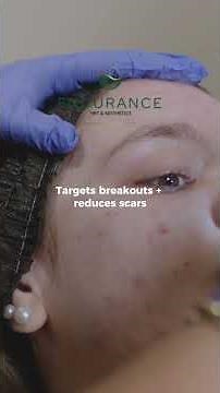 How Plexr Plasma Helps Reduce Acne Scars and Skin Texture #shorts