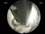 L5 Left Highly Down Migrated Disc • Video • MEDtube.net