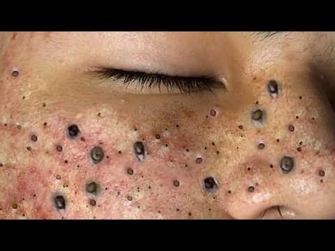 Intense Blackhead Extraction | Acne Treatment & Deep Cleansing