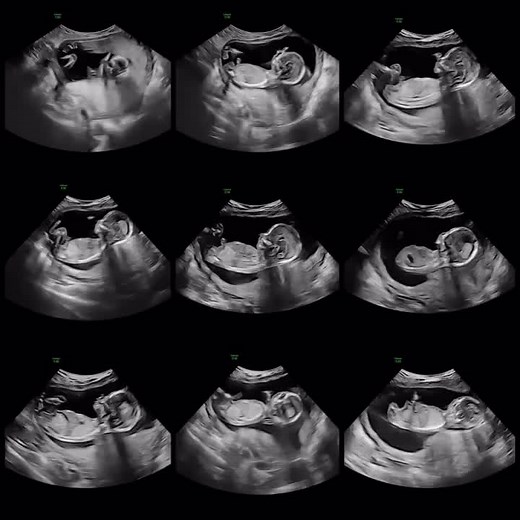 15 week Sonogram #baby #sonogram #ultrasound #pregnant #pregnancyannouncement #itsagirl #photooftheday #pregnancylife #pregnanttiktok #fypシ