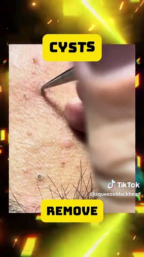 Effective Blackhead Removal Techniques for Clear Skin