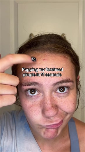Sorry kinda lame😔 #pimplepopping #pimplepopper #drpimplepopper #pimples #skincaretok