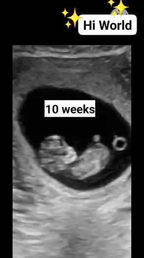 3.8K views · 2K reactions | 10 weeks baby moving in the womb #fblifestyle #radiology #ultrasound #pregnancy #embryo | Radiology Interesting | Facebook
