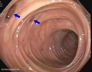 Seeds, popcorn, and nuts in diverticulitis: fact and fiction