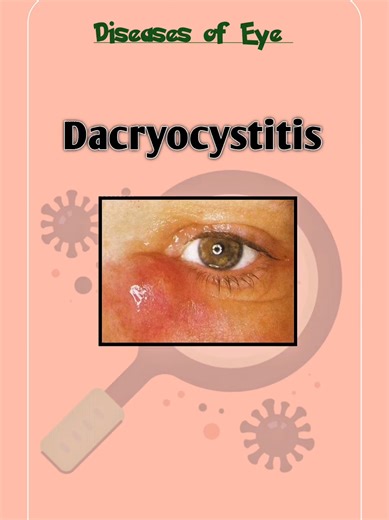 Understanding Dacryocystitis: Causes, Symptoms, and Treatment