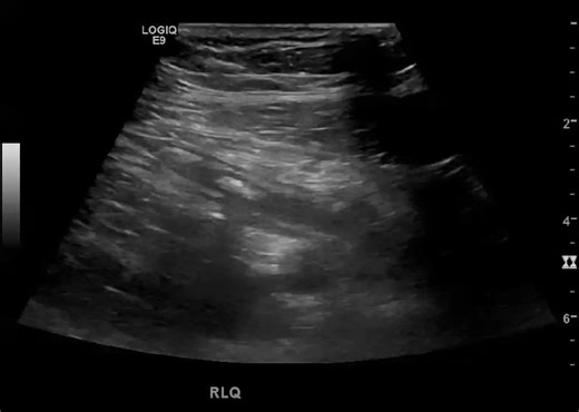 POCUS Pearl: Sonographic Signs of Appendicitis | POCUS Focused posted on the topic | LinkedIn