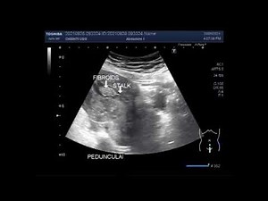 Fibroid uterus type Pedunculated submucosal Fibroids.