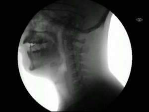 X-ray Video Of A Person Swallowing Food and Water | Medical Talks